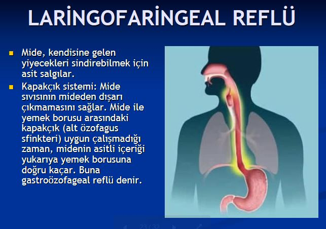 boğaz-reflusu