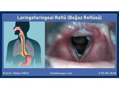 bogaz-reflusu-tedavisi