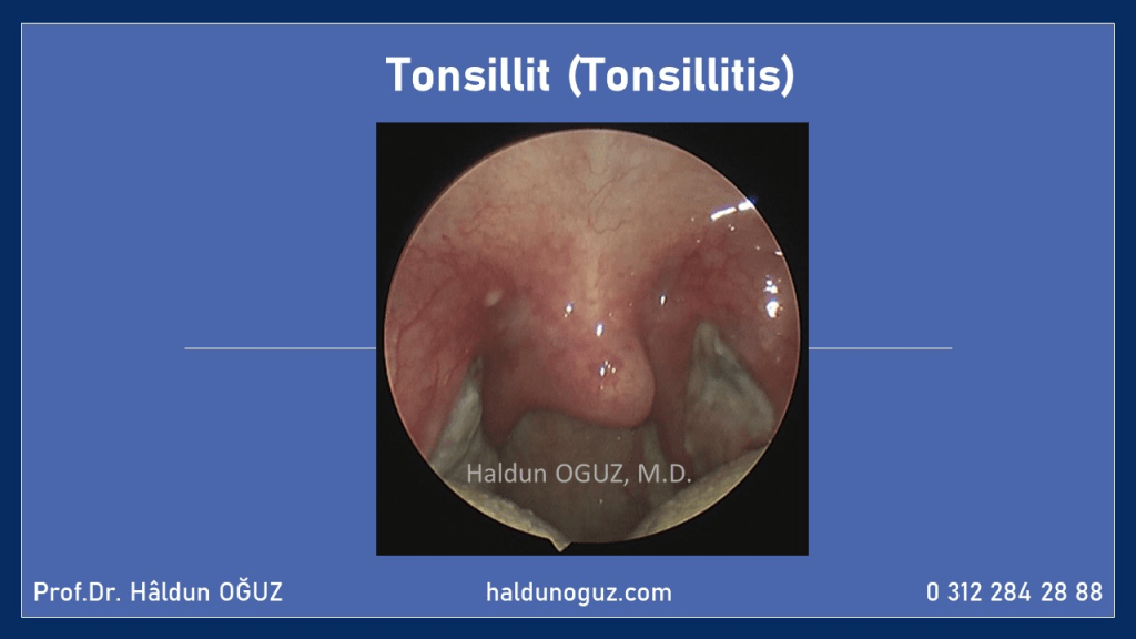 tonsillit