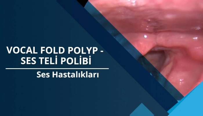 vocal-fold-polyp-haldun-oguz-m-d