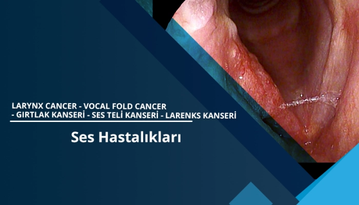 larynx-cancer-vocal-fold-cancer-girtlak-kanseri-ses-teli-kanseri-larenks-kanseri