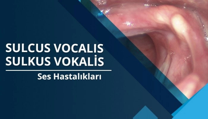 sulcus-vocalis
