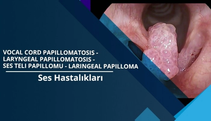 vocal-cord-papillomatosis-laryngeal-papillomatosis