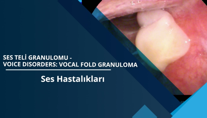 ses-teli-granulomu-vocal-fold-granuloma