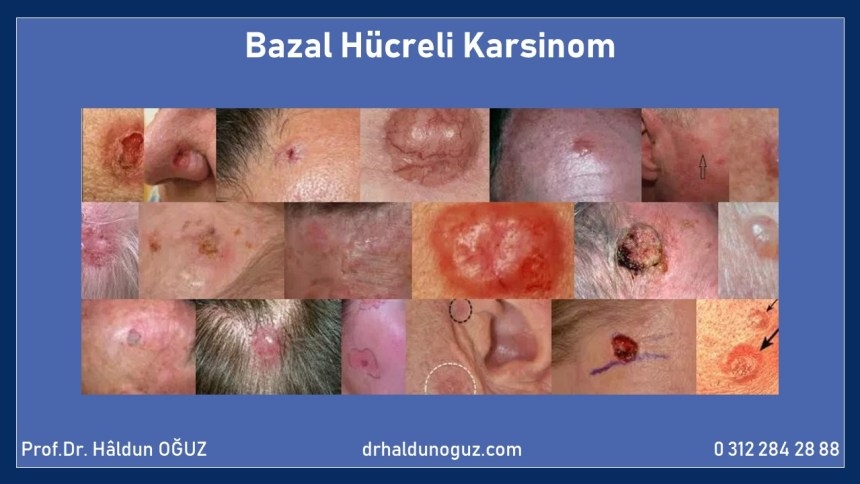 bazal-hucreli-karsinom
