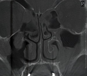 burun-eti-buyumesi-2-1