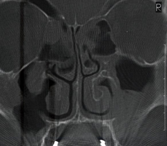 burun-eti-buyumesi-2