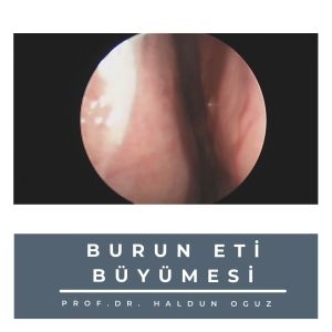 burun-eti-buyumesi-300x300