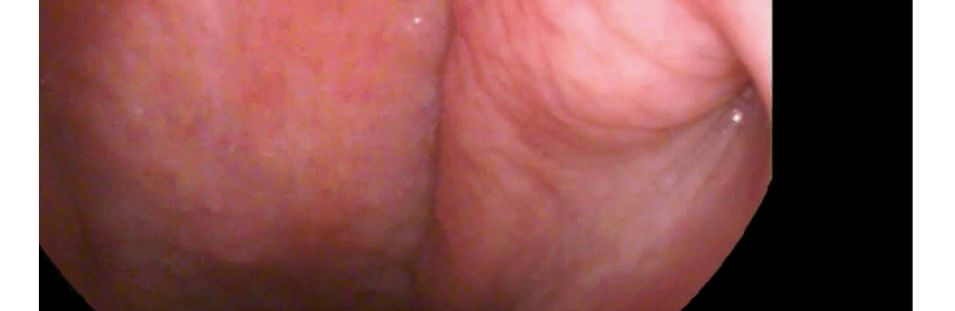 chip-on-tip-laringoskopi