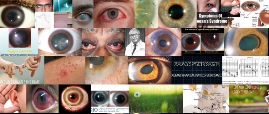 cogan-syndorme