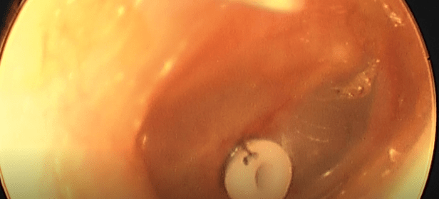 kulak-tupu-ve-geniz-eti-ameliyati