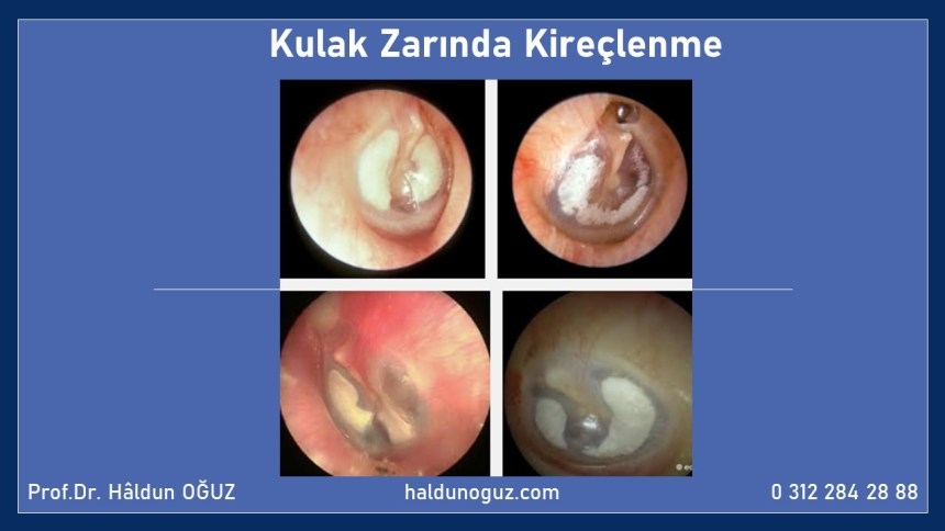 kulak-zari-kireclenmesi-haldun-oguz