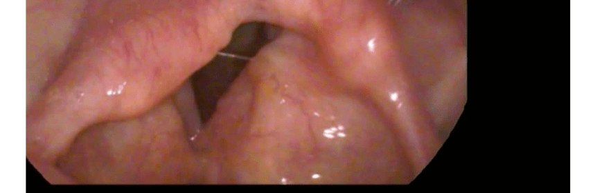 laringeal-amiloidoz-foto