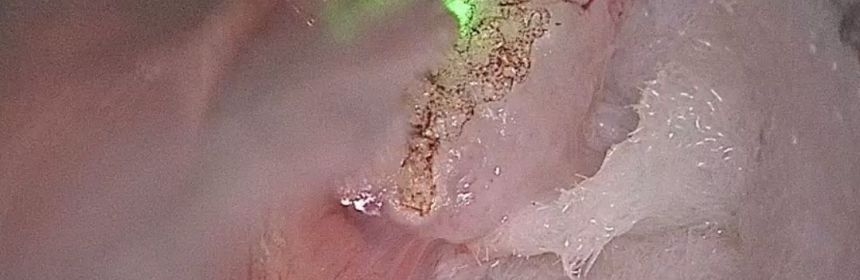 lazerle-ses-teli-ameliyati