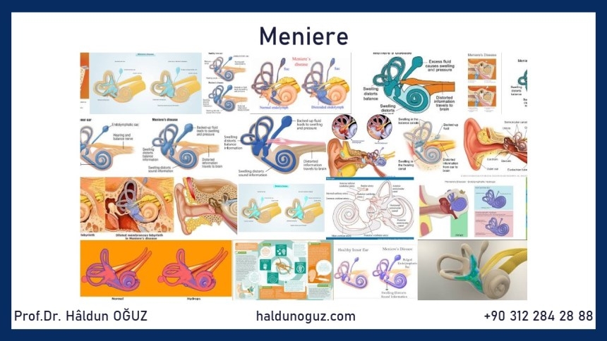 meniere