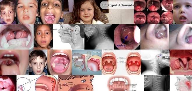 oguz-adenoid-geniz-eti1