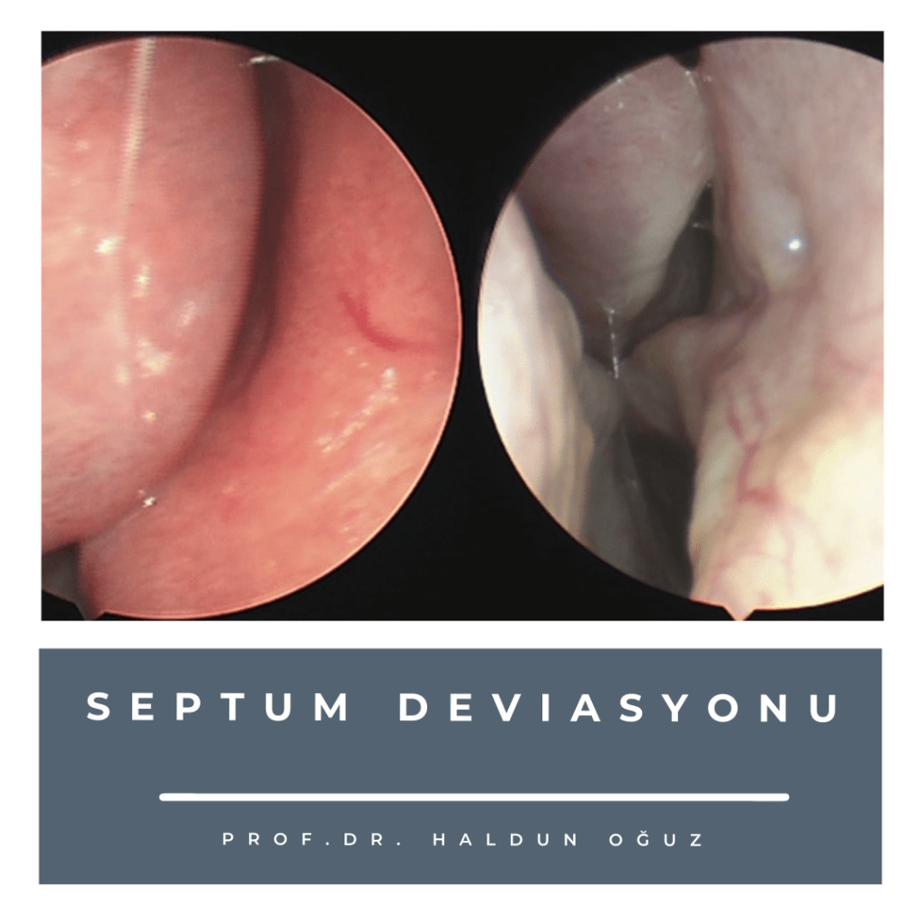 septum-deviasyonu-1