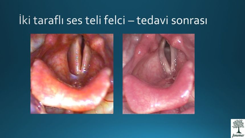 ses-teli-felci