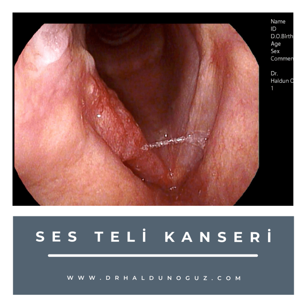 ses-teli-kanseri