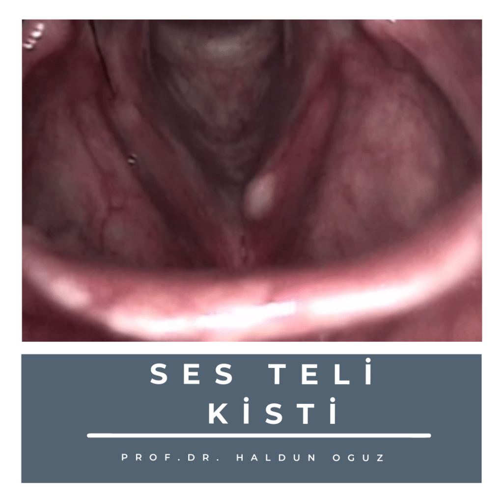 ses-teli-kisti-1