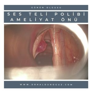 ses-teli-polibi-ameliyat-oncesi