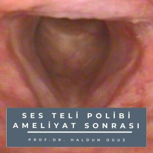 ses-teli-polibi-ses-ameliyati-sonrasi