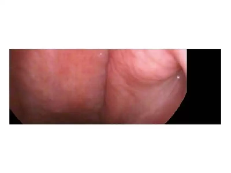 Chip On Tip Laringoskopi