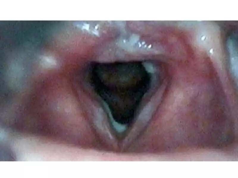 Gastroözefageal Reflü