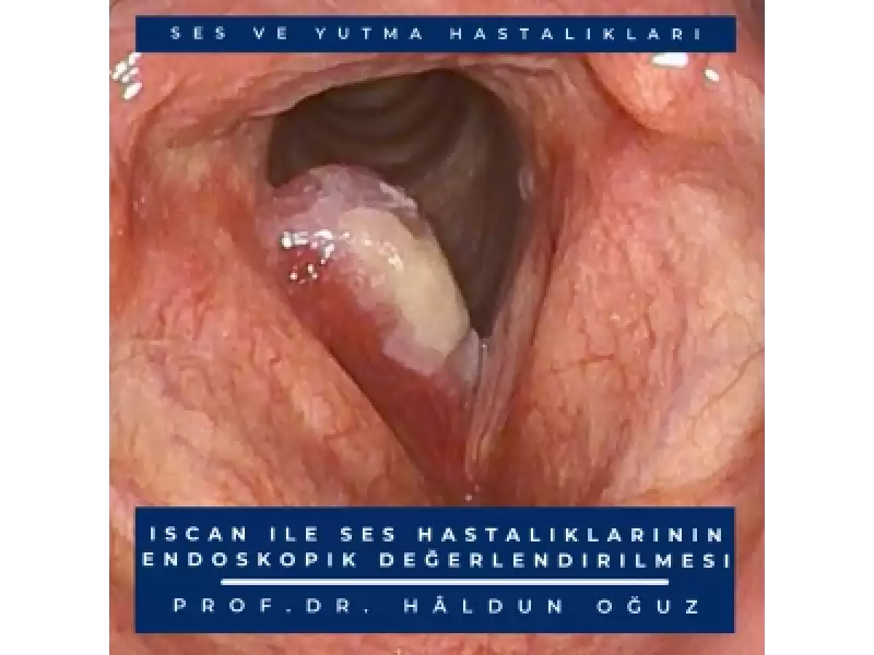 iSCAN ile Ses Tellerinin Endoskopik Değerlendirilmesi