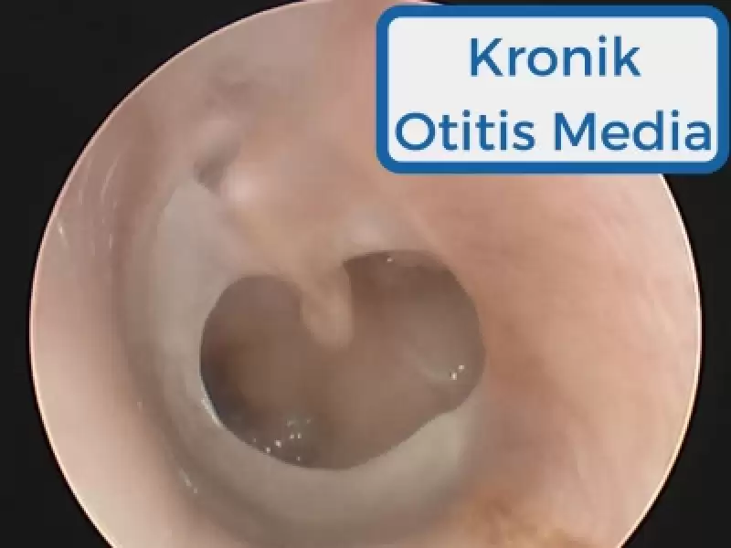 Kronik Otitis Media (Kronik Orta Kulak İltihabı)