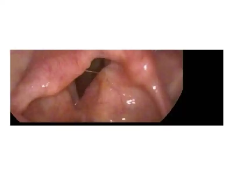 Laringeal Amiloidoz