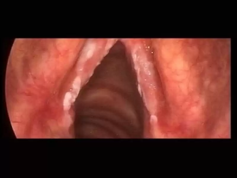 Ses Teli Kanseri: Riskli Lezyonlar