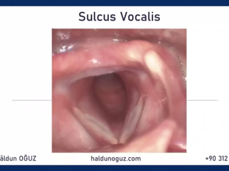Sulkus Vokalis