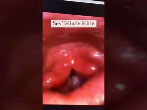 ses ameliyatı,ses cerrahisi,ses teli felci,ses tedavisi,ses terapisi,ses inceltme,ses kalınlaştırma,ses estetiği,ses teli kanseri,gırtlak kanseri,geniz eti,burun ameliyatı,kulak tüpü,çocuk kbb,horlama ameliyatı,kulak burun boğaz profesörü,an