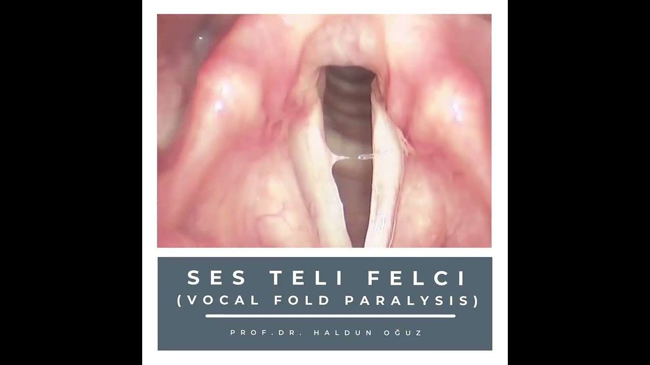 ses ameliyatı,ses cerrahisi,ses teli felci,ses tedavisi,ses terapisi,ses inceltme,ses kalınlaştırma,ses estetiği,ses teli kanseri,gırtlak kanseri,geniz eti,burun ameliyatı,kulak tüpü,çocuk kbb,horlama ameliyatı,kulak burun boğaz profesörü,an