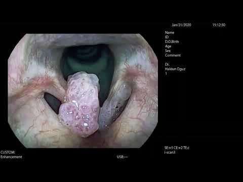 ses ameliyatı,ses cerrahisi,ses teli felci,ses tedavisi,ses terapisi,ses inceltme,ses kalınlaştırma,ses estetiği,ses teli kanseri,gırtlak kanseri,geniz eti,burun ameliyatı,kulak tüpü,çocuk kbb,horlama ameliyatı,kulak burun boğaz profesörü,an