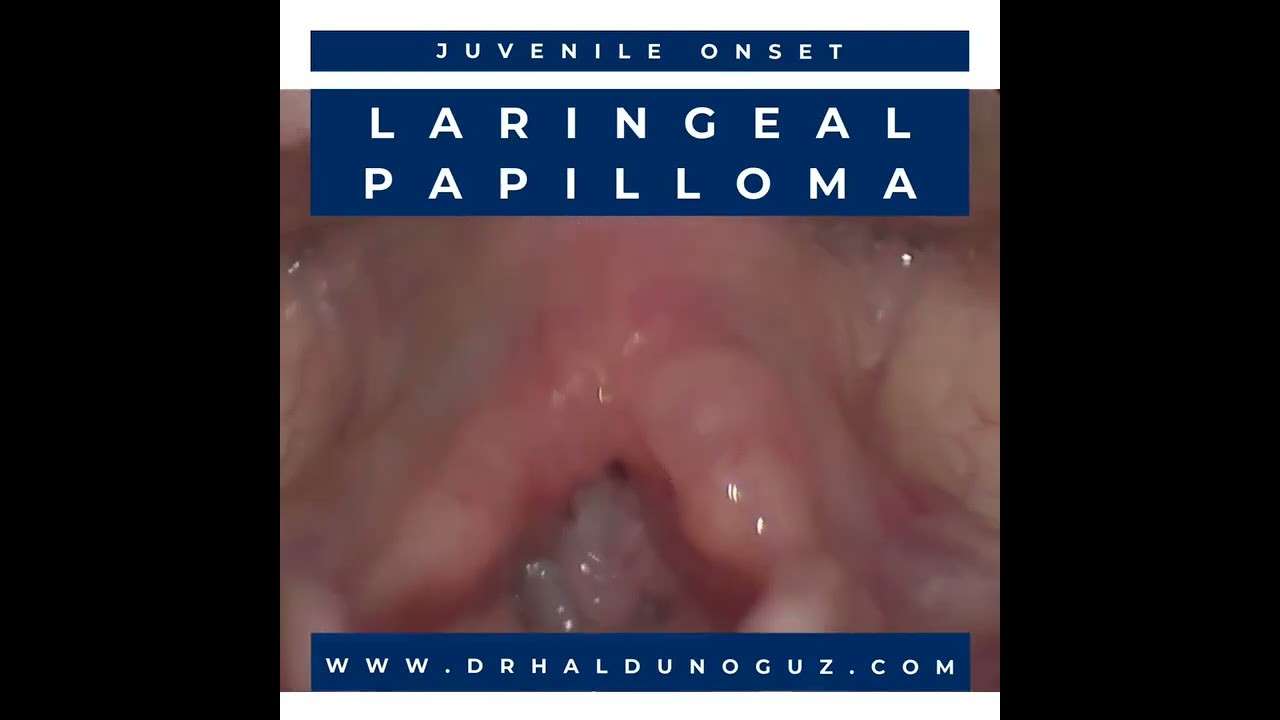 ses ameliyatı,ses cerrahisi,ses teli felci,ses tedavisi,ses terapisi,ses inceltme,ses kalınlaştırma,ses estetiği,ses teli kanseri,gırtlak kanseri,geniz eti,burun ameliyatı,kulak tüpü,çocuk kbb,horlama ameliyatı,kulak burun boğaz profesörü,an