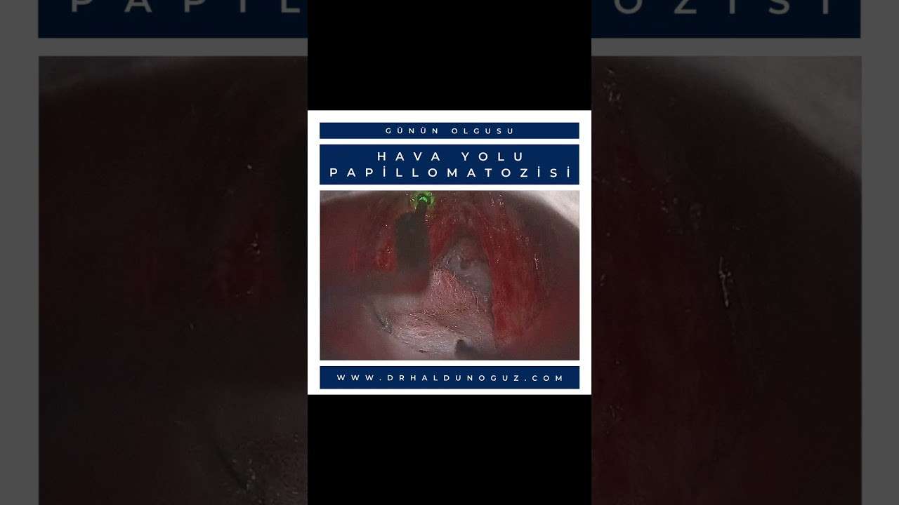 ses ameliyatı,ses cerrahisi,ses teli felci,ses tedavisi,ses terapisi,ses inceltme,ses kalınlaştırma,ses estetiği,ses teli kanseri,gırtlak kanseri,geniz eti,burun ameliyatı,kulak tüpü,çocuk kbb,horlama ameliyatı,kulak burun boğaz profesörü,an