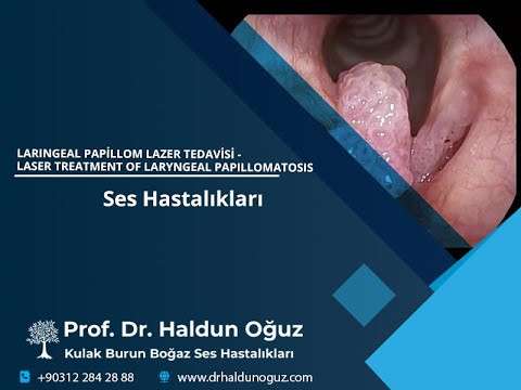 ses ameliyatı,ses cerrahisi,ses teli felci,ses tedavisi,ses terapisi,ses teli kanseri,gırtlak kanseri,ses teli lazer tedavisi,laser laryngeal treatment,vocal cord laser treatment,lazer ses tedavisi