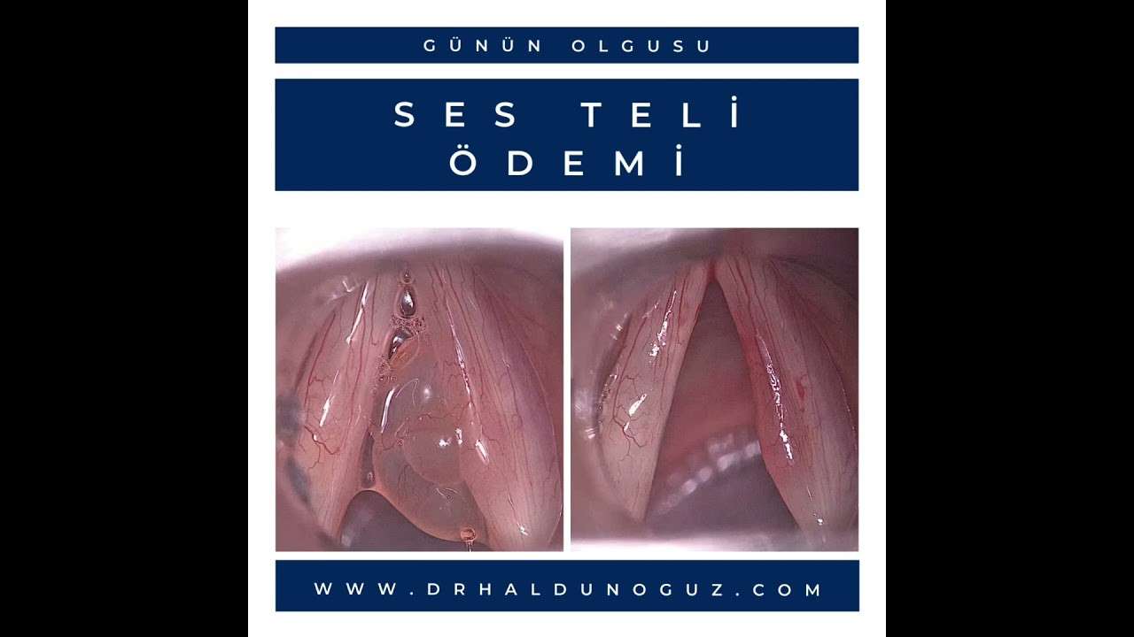 ses ameliyatı,ses cerrahisi,ses teli felci,ses tedavisi,ses terapisi,ses inceltme,ses kalınlaştırma,ses estetiği,ses teli kanseri,gırtlak kanseri,geniz eti,burun ameliyatı,kulak tüpü,çocuk kbb,horlama ameliyatı,kulak burun boğaz profesörü,an