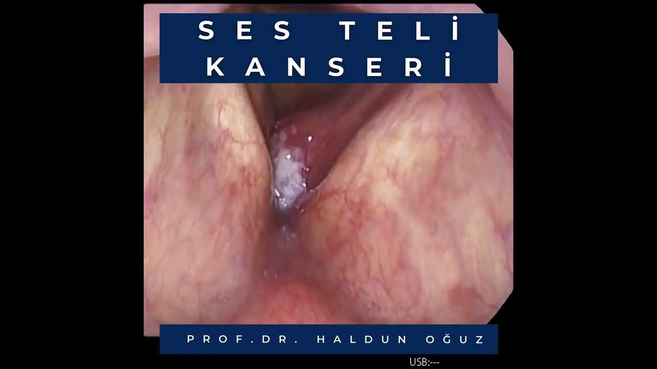 ses ameliyatı,ses cerrahisi,ses teli felci,ses tedavisi,ses terapisi,ses inceltme,ses kalınlaştırma,ses estetiği,ses teli kanseri,gırtlak kanseri,geniz eti,burun ameliyatı,kulak tüpü,çocuk kbb,horlama ameliyatı,kulak burun boğaz profesörü,an