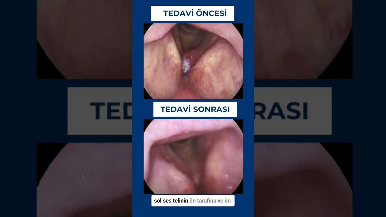 ses ameliyatı,ses cerrahisi,ses teli felci,ses tedavisi,ses terapisi,ses inceltme,ses kalınlaştırma,ses estetiği,ses teli kanseri,gırtlak kanseri,geniz eti,burun ameliyatı,kulak tüpü,çocuk kbb,horlama ameliyatı,kulak burun boğaz profesörü,an