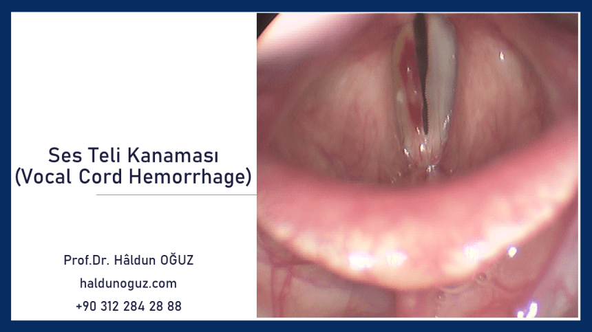 vocal-cord-hemorrhage-1