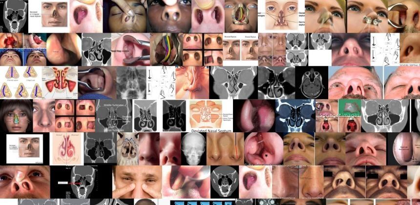 septum-deviasyonu-burun-egriligi-nedir
