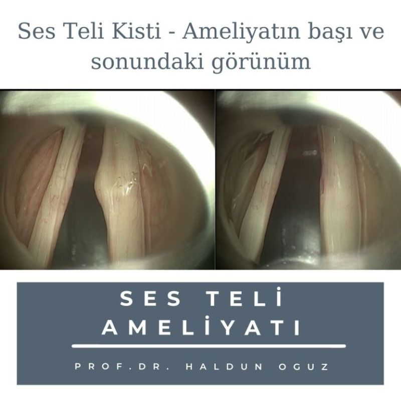 ses-teli-kisti-ameliyati